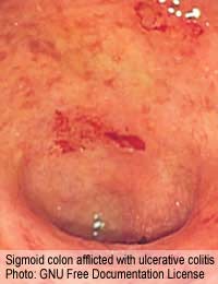 Ulcerative Colitis Crohn’s Disease Bowel