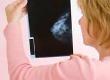 What are Mammograms?