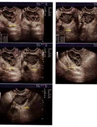 Ovarian Cysts; Cancer; Dermoid;