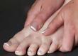 Prevention & Treatment for Bunions