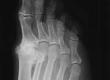 Diagnosing & Treating Osteoarthritis