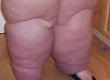 Lymphedema: What Causes It?
