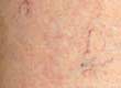 All About Varicose Veins