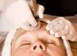 What is Dermabrasion?