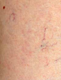 Varicose Veins Valves Blood Supply Blood